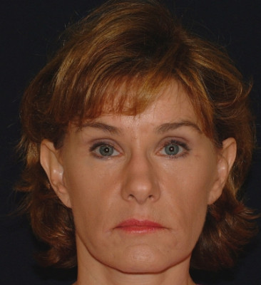 Blepharoplasty Patient Photo - Case 4053 - after view