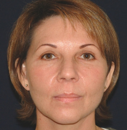 Injectables Patient Photo - Case 4074 - after view
