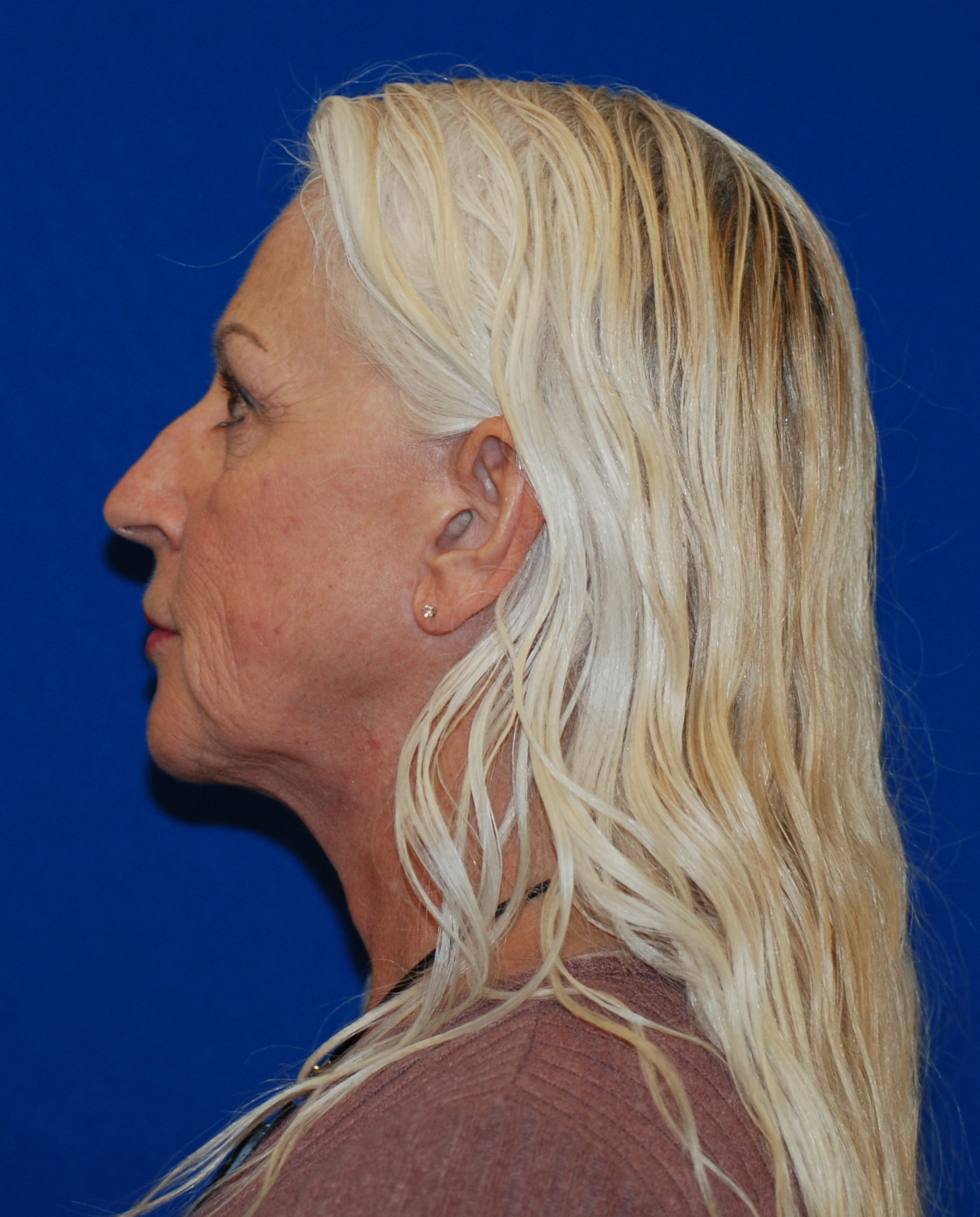 Rhinoplasty Patient Photo - Case 4081 - before view-