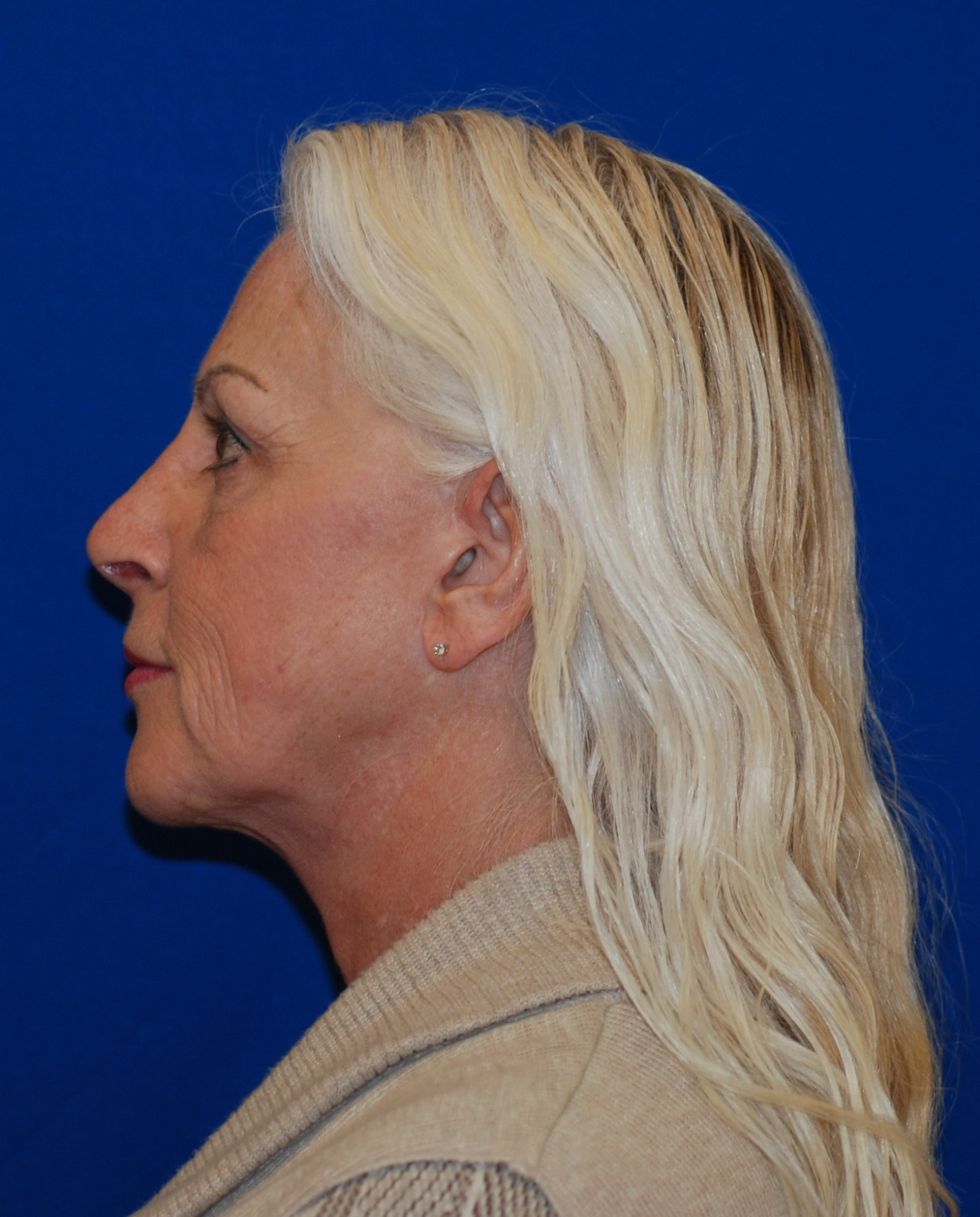 Rhinoplasty Patient Photo - Case 4081 - after view