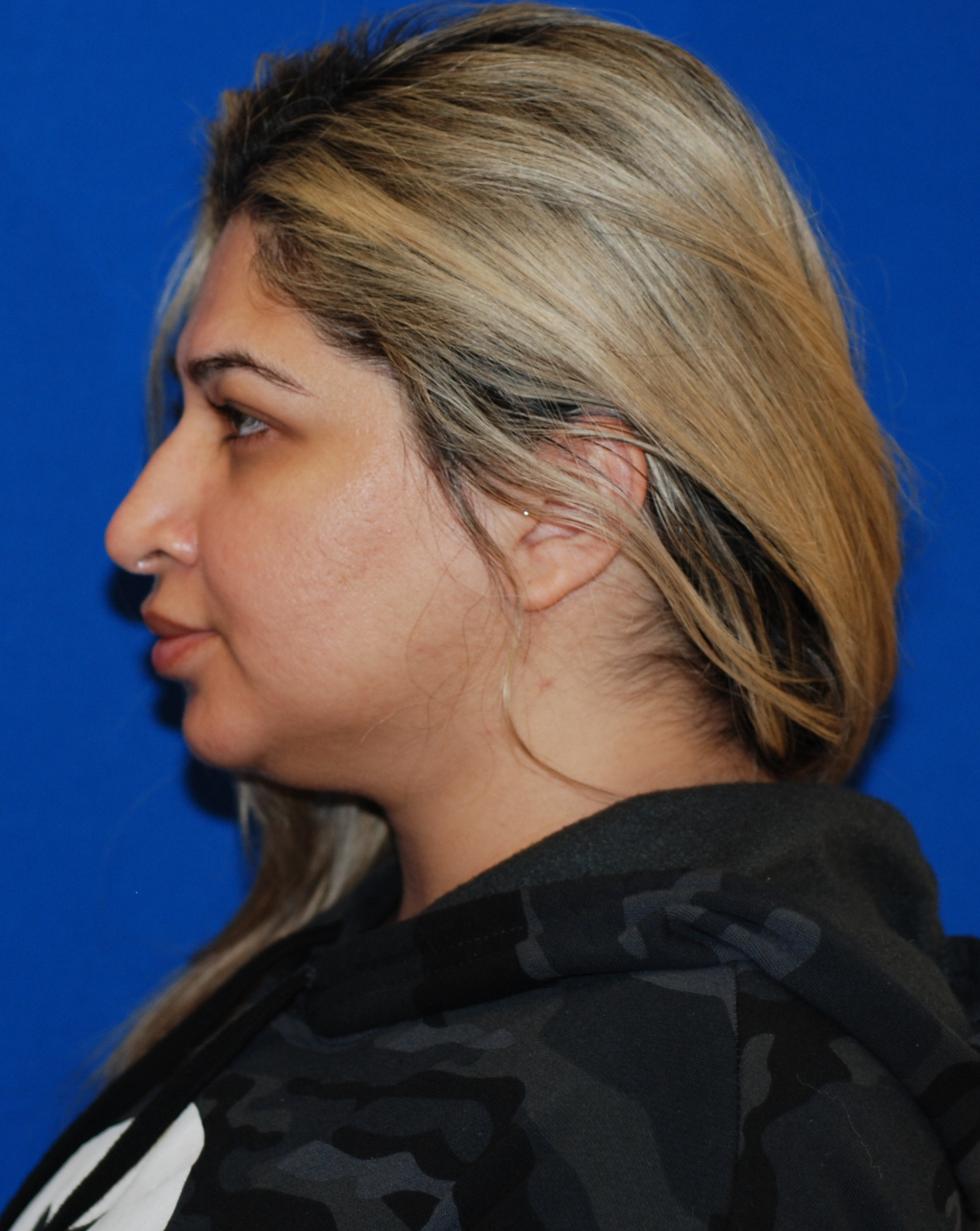 Rhinoplasty Patient Photo - Case 4084 - before view-0