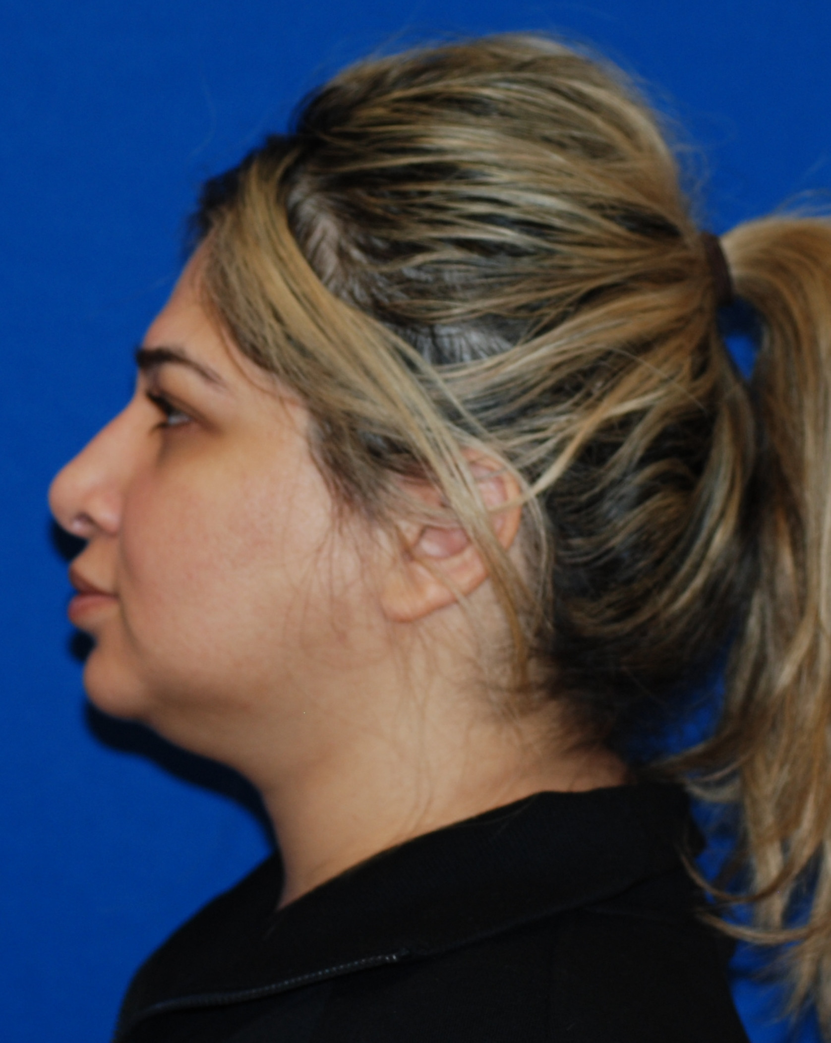 Rhinoplasty Patient Photo - Case 4084 - after view-0