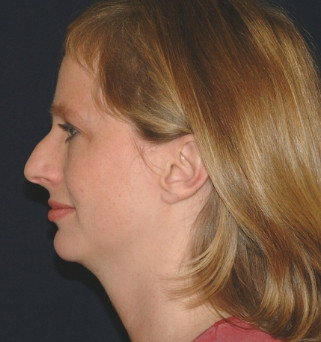Rhinoplasty Patient Photo - Case 4096 - after view