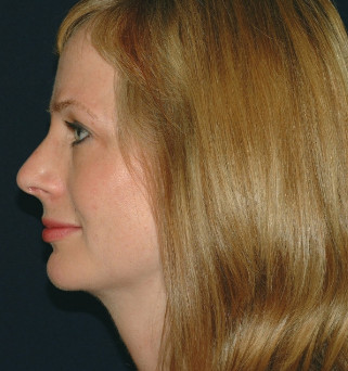 Rhinoplasty Patient Photo - Case 4096 - before view-