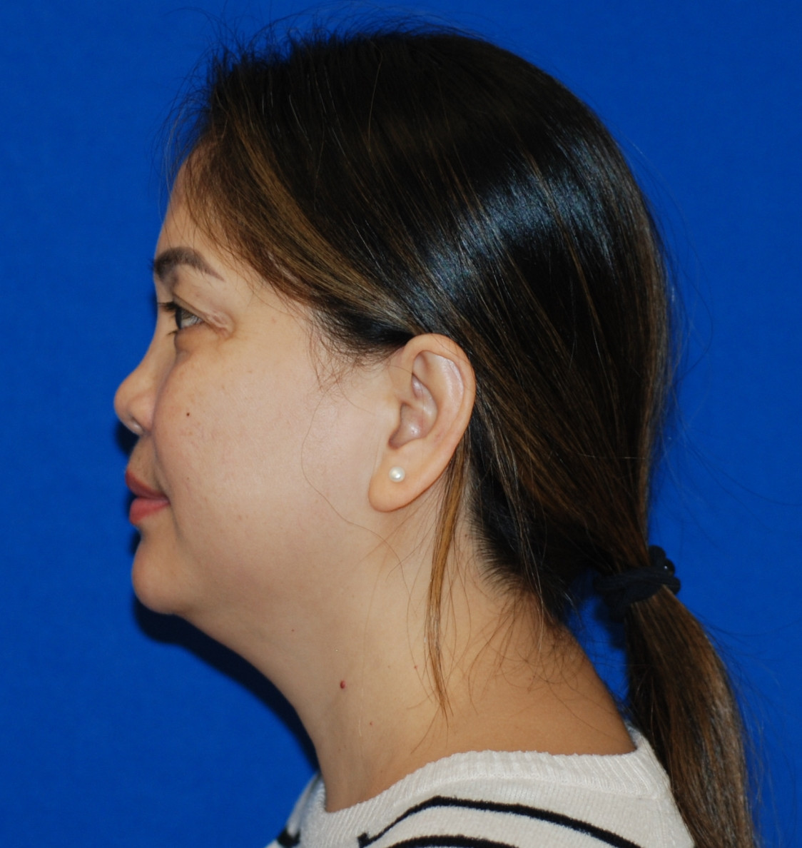 Rhinoplasty Patient Photo - Case 4099 - after view