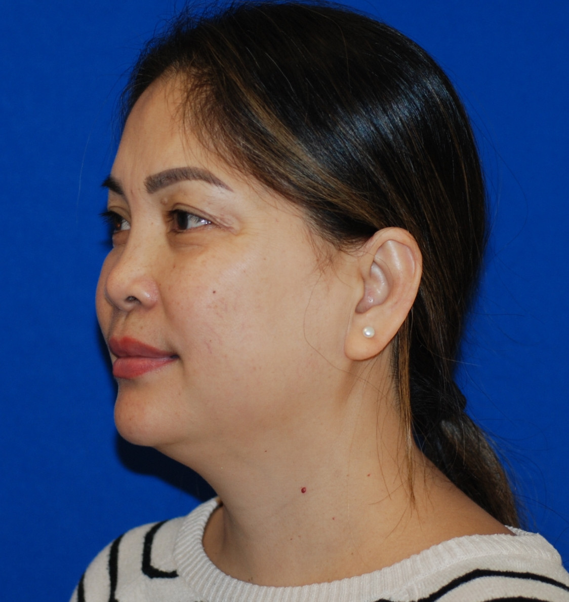 Rhinoplasty Patient Photo - Case 4099 - after view