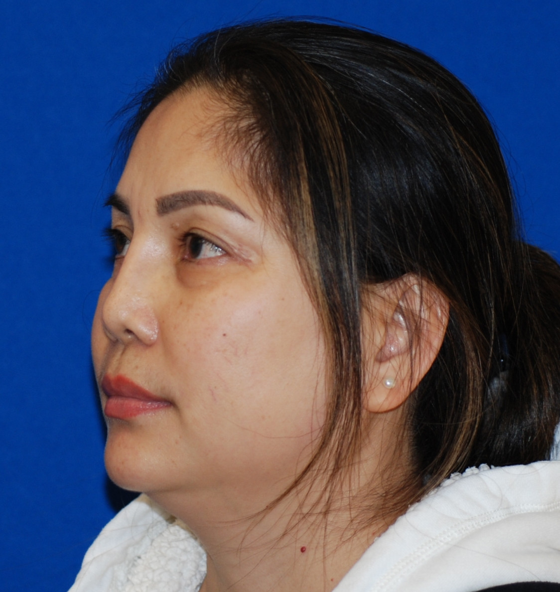 Rhinoplasty Patient Photo - Case 4099 - before view-