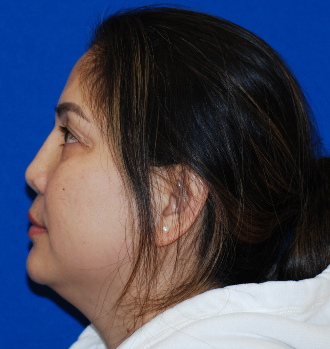 Rhinoplasty Patient Photo - Case 4099 - before view-0