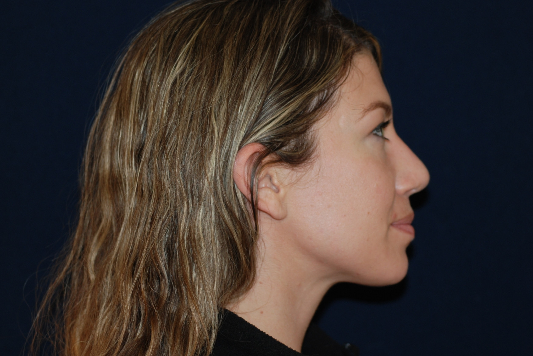 Rhinoplasty Patient Photo - Case 4110 - after view-1