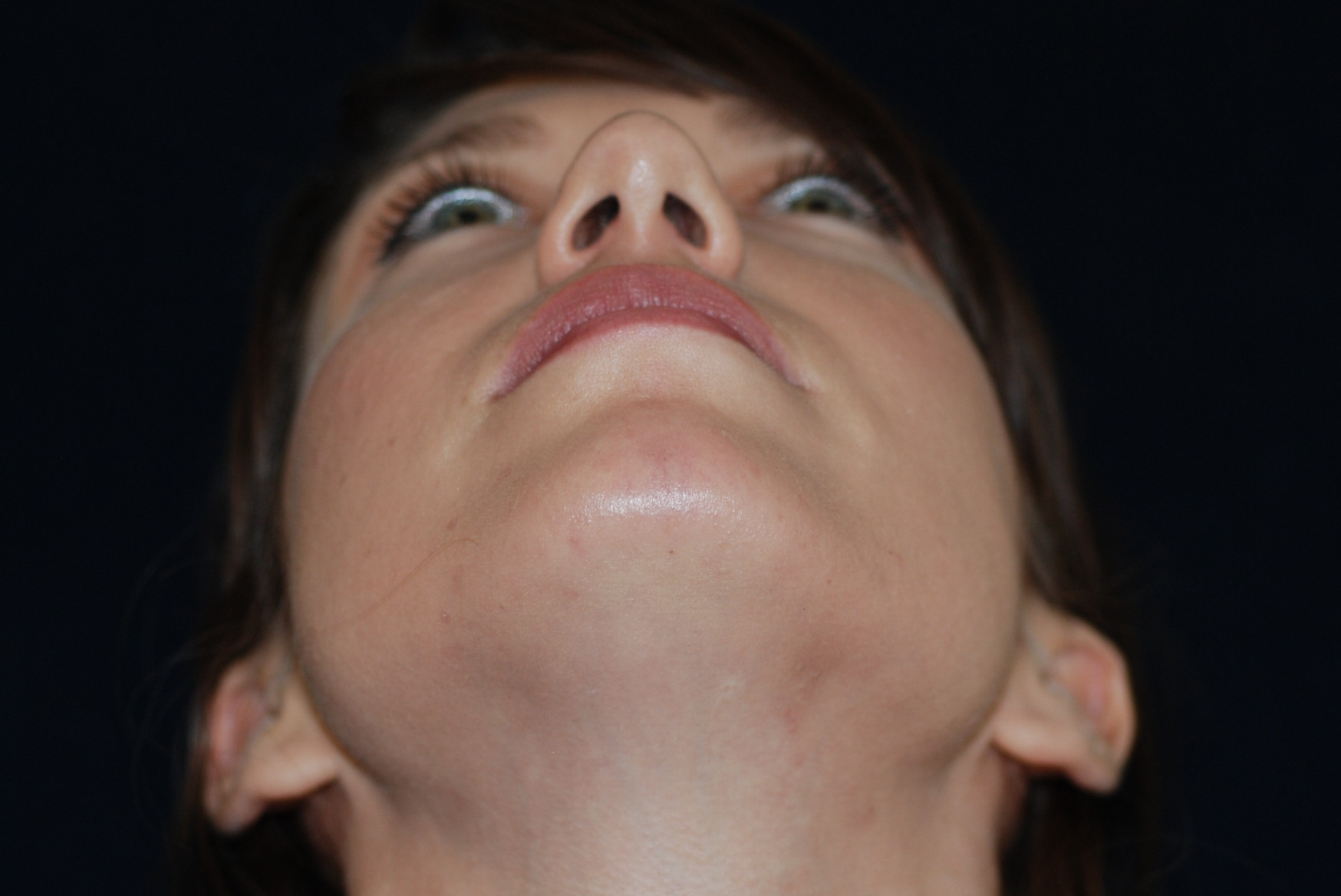 Rhinoplasty Patient Photo - Case 4110 - before view-4