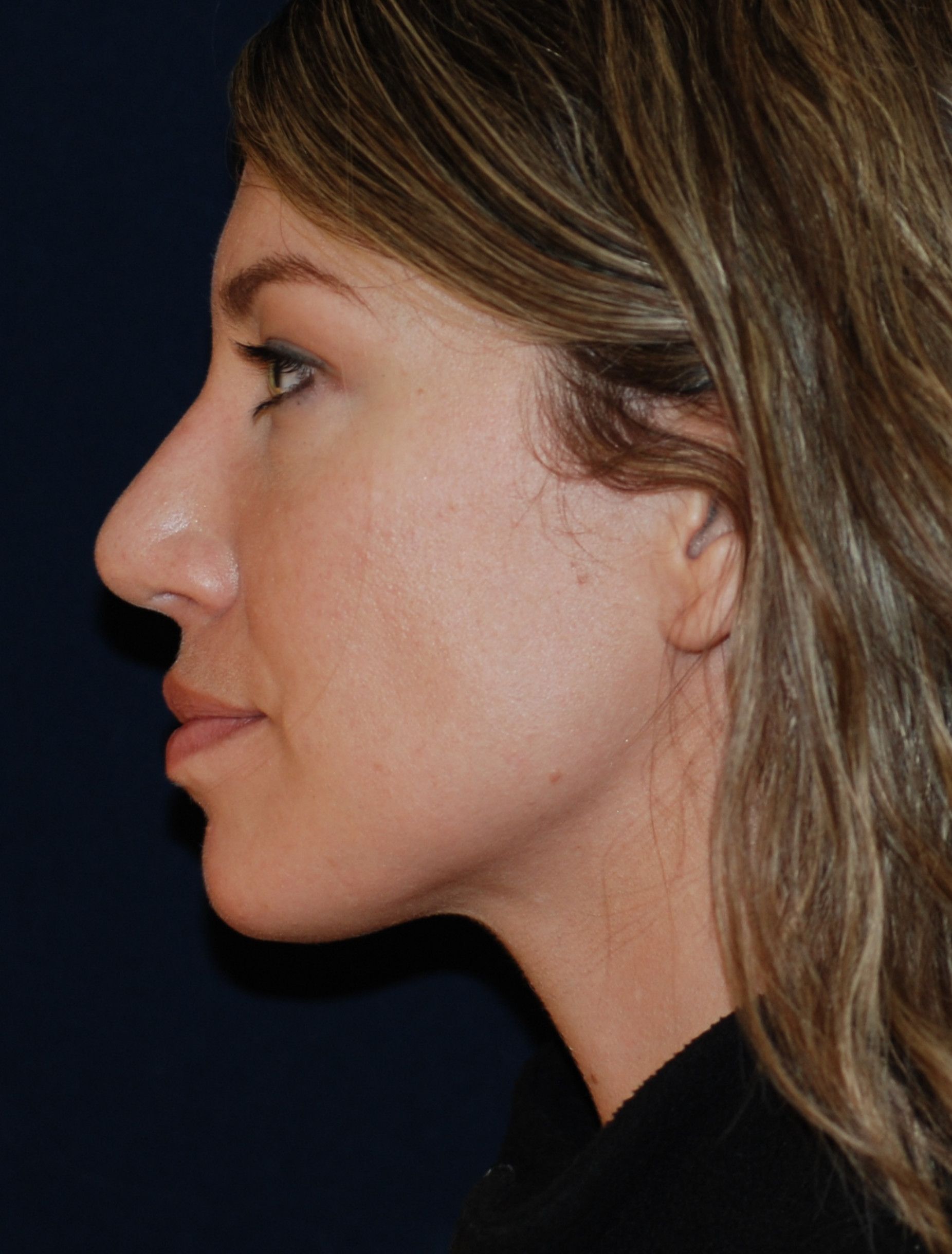 Rhinoplasty Patient Photo - Case 4110 - after view-0