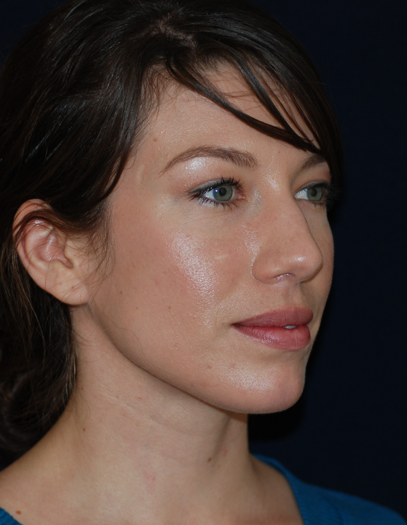 Rhinoplasty Patient Photo - Case 4110 - before view-