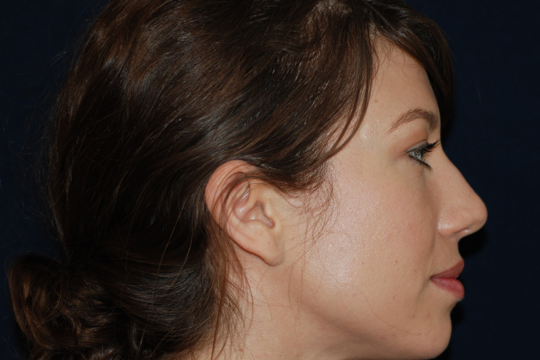 Rhinoplasty Patient Photo - Case 4110 - before view-1
