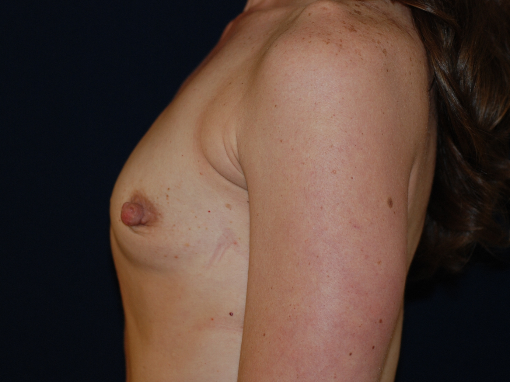 Breast Augmentation Patient Photo - Case 4123 - before view-2