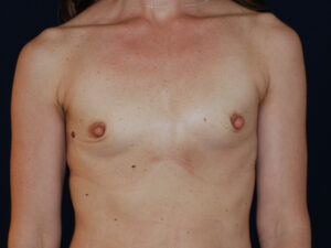 Breast Augmentation - Case 4123 - Before
