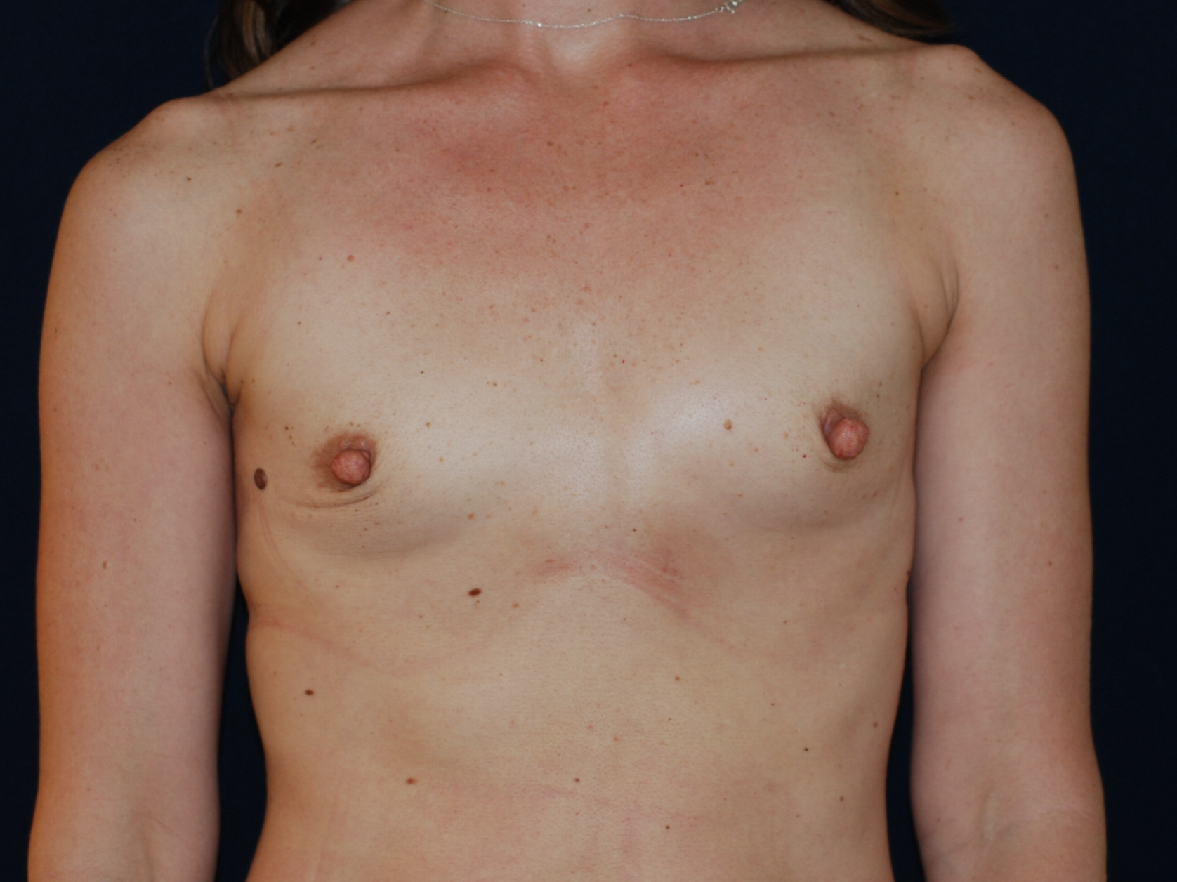 Breast Augmentation Patient Photo - Case 4123 - before view-0