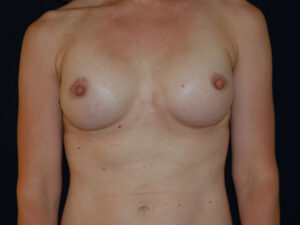 Breast Augmentation - Case 4123 - After