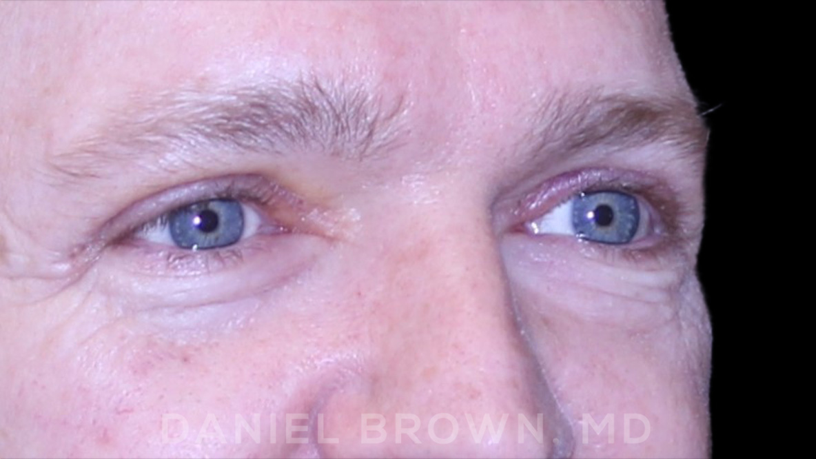 Blepharoplasty Patient Photo - Case 832 - after view