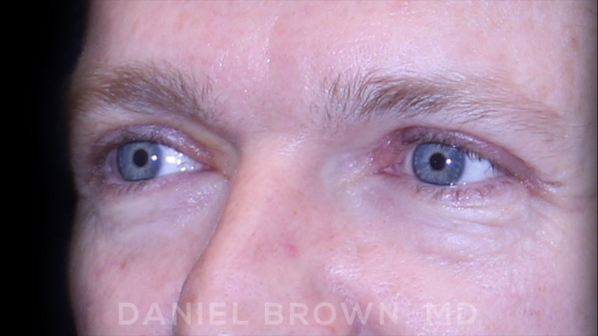 Blepharoplasty Patient Photo - Case 832 - after view