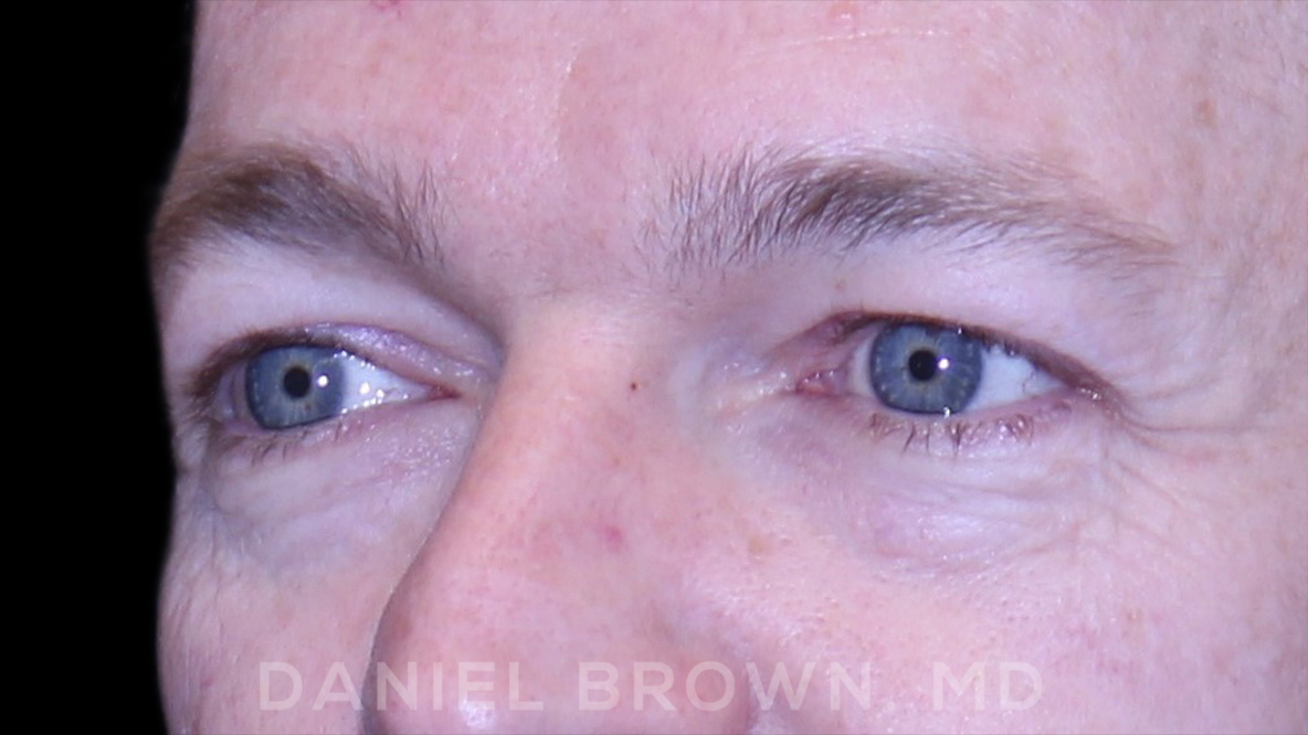 Blepharoplasty Patient Photo - Case 832 - before view-