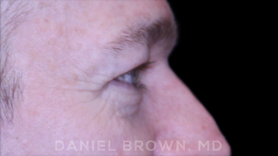 Blepharoplasty Patient Photo - Case 832 - before view-8