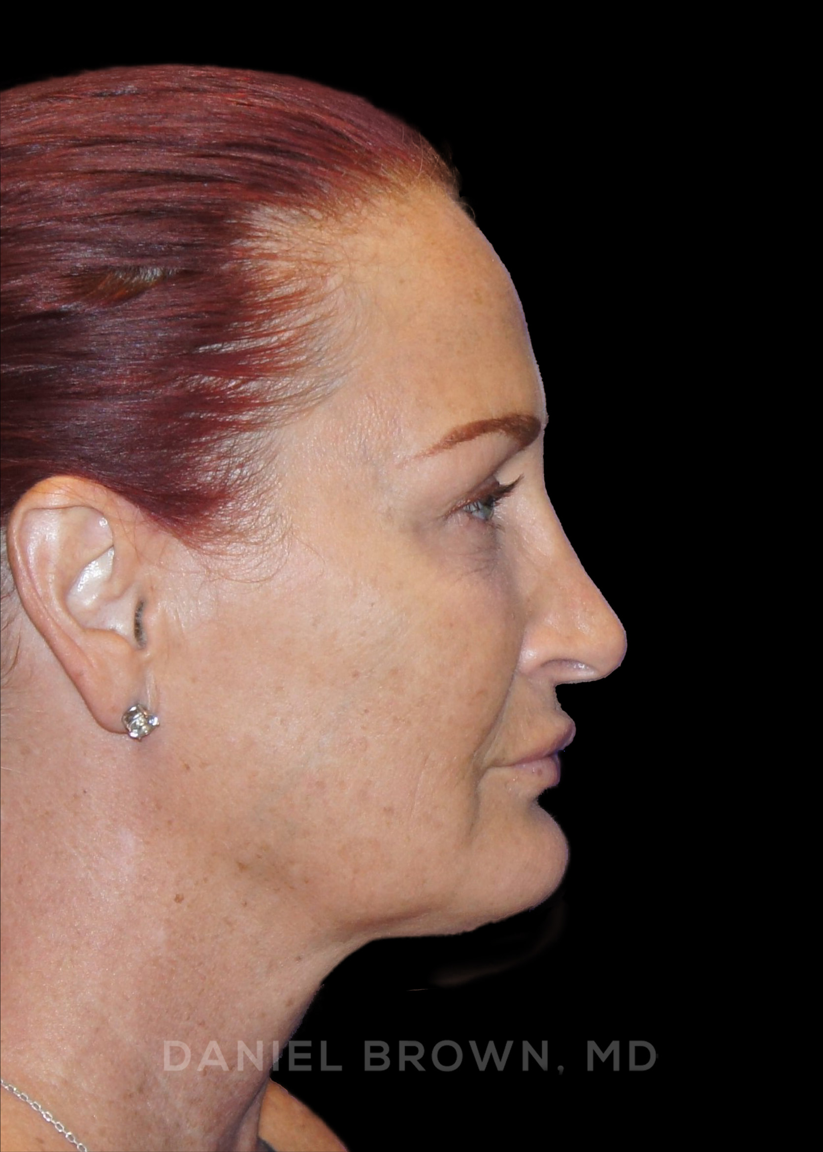 Blepharoplasty Patient Photo - Case 852 - after view