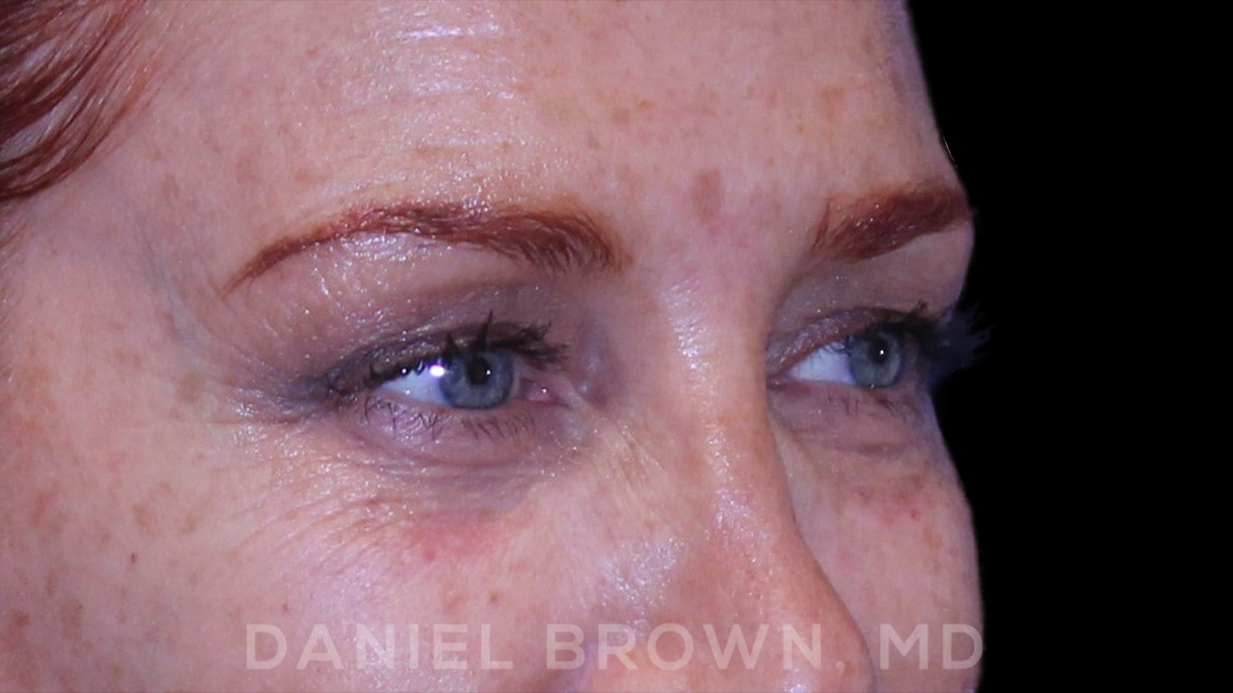 Blepharoplasty Patient Photo - Case 852 - before view-4
