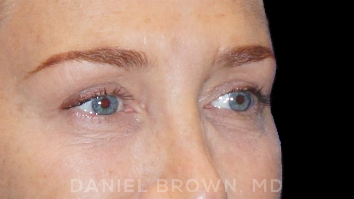 Blepharoplasty Patient Photo - Case 852 - after view-4