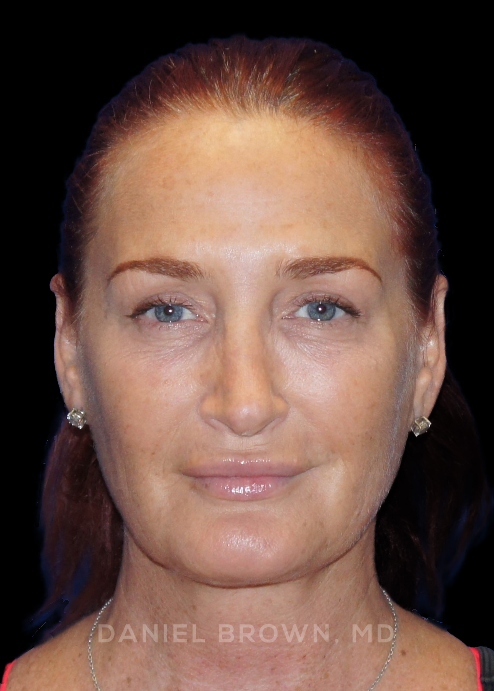 Blepharoplasty Patient Photo - Case 852 - after view-0
