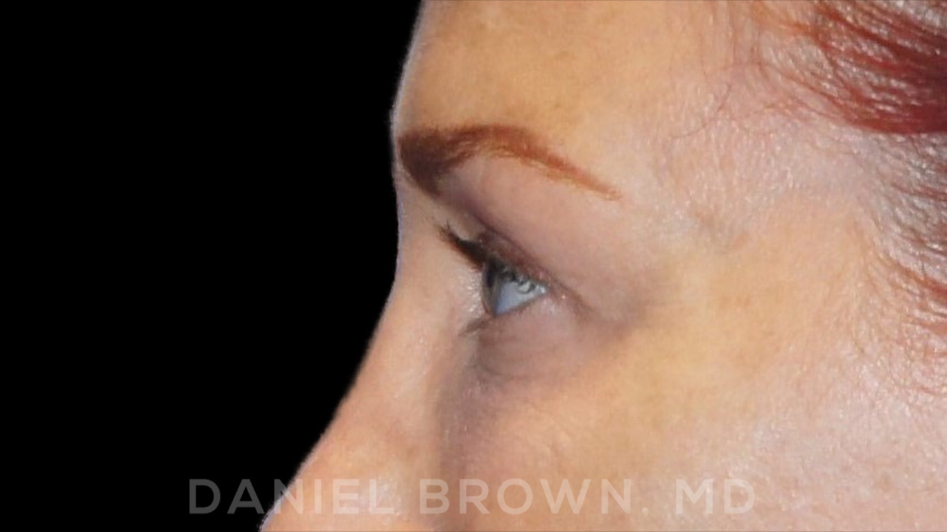 Blepharoplasty Patient Photo - Case 852 - after view-7