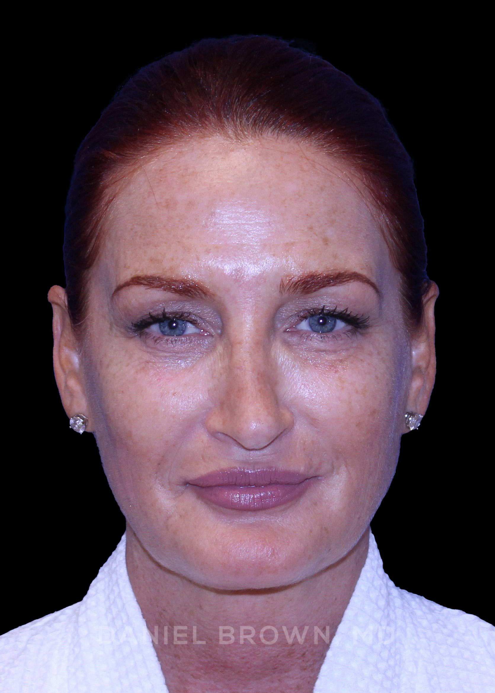 Blepharoplasty Patient Photo - Case 852 - before view-