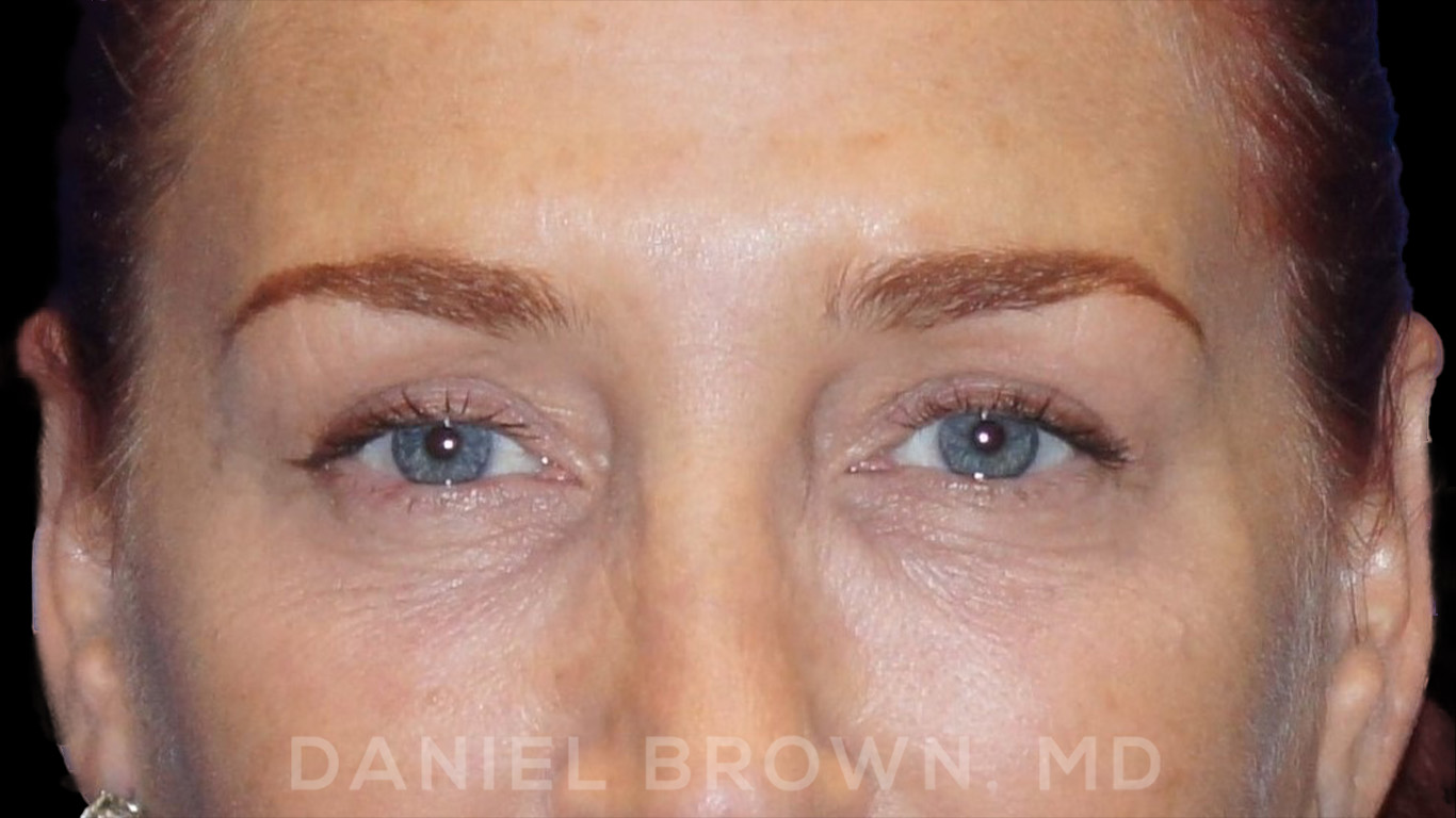 Blepharoplasty Patient Photo - Case 852 - after view-1