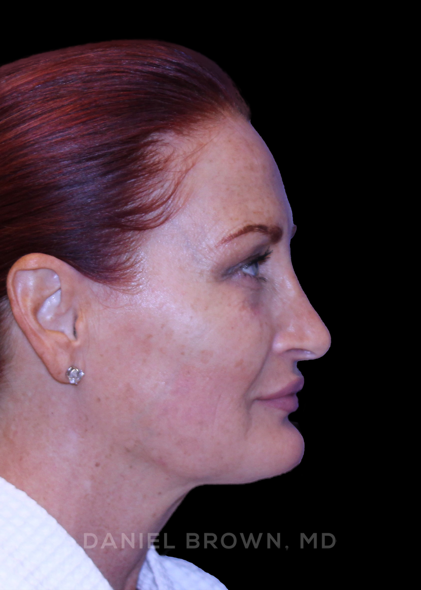 Blepharoplasty Patient Photo - Case 852 - before view-