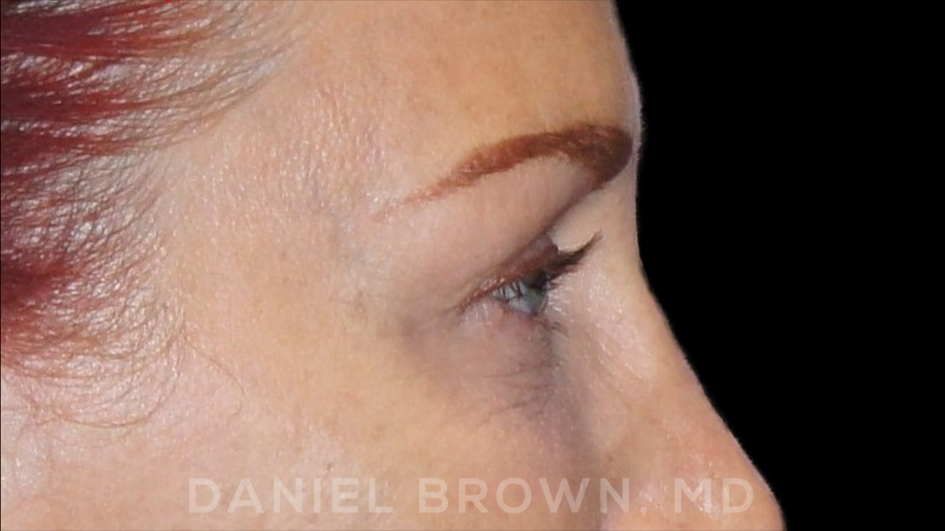 Blepharoplasty Patient Photo - Case 852 - after view