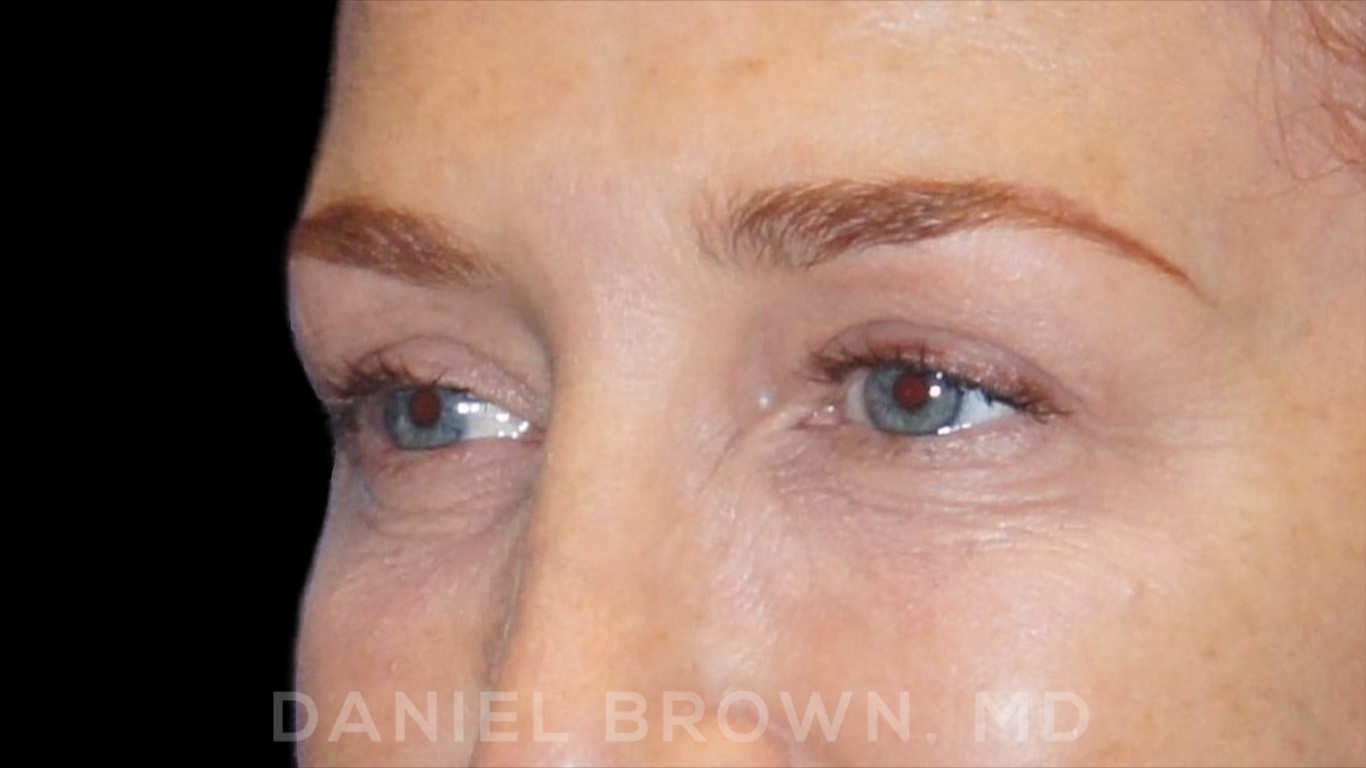 Blepharoplasty Patient Photo - Case 852 - after view-2