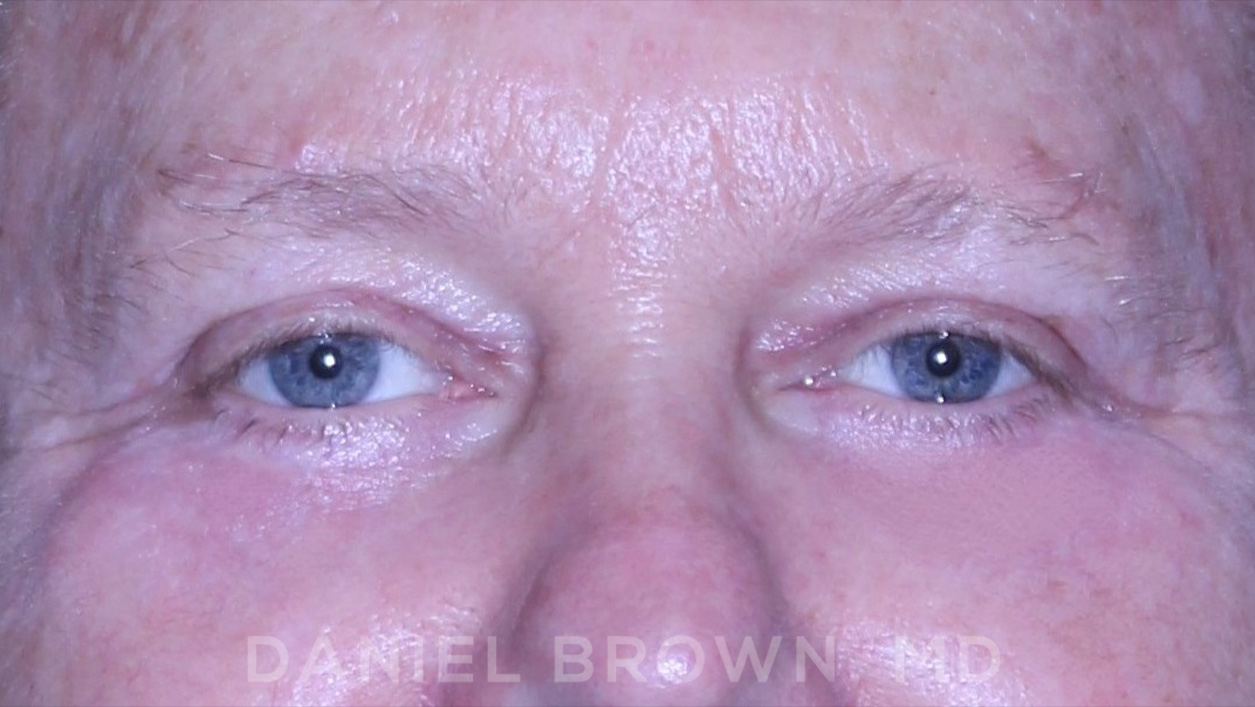 Blepharoplasty Patient Photo - Case 873 - after view-1