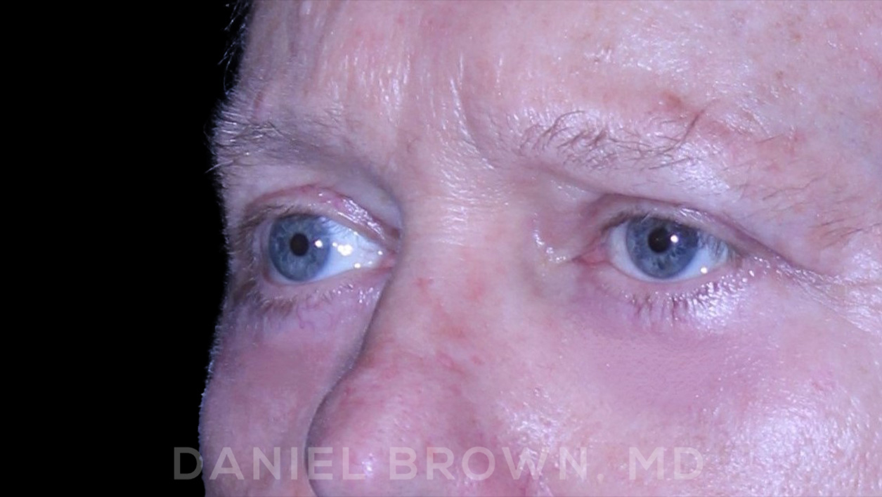 Blepharoplasty Patient Photo - Case 873 - after view