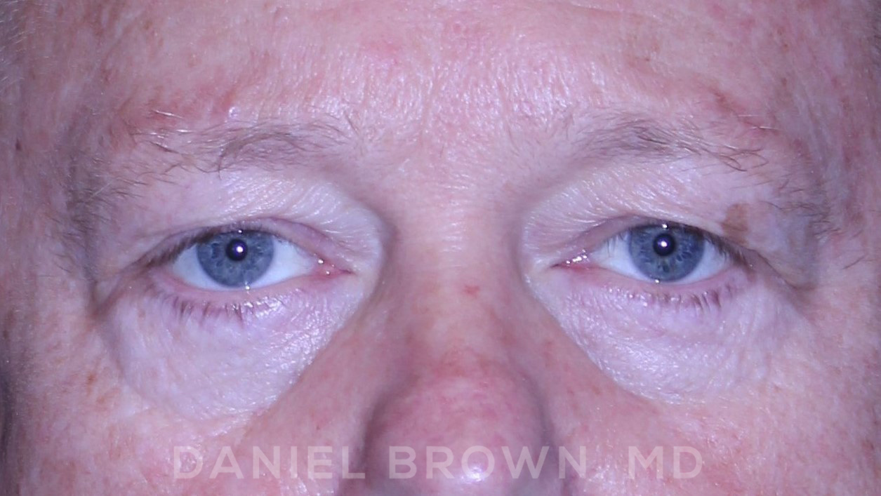 Blepharoplasty Patient Photo - Case 873 - before view-1