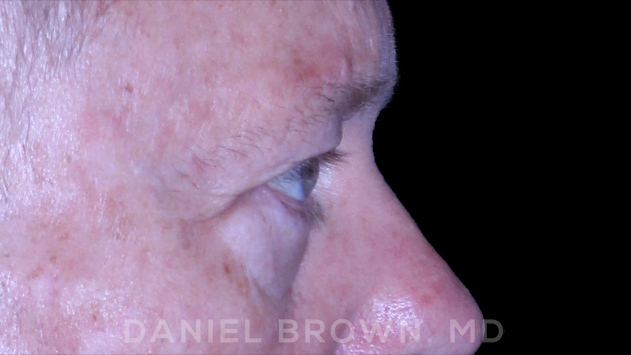 Blepharoplasty Patient Photo - Case 873 - before view-7