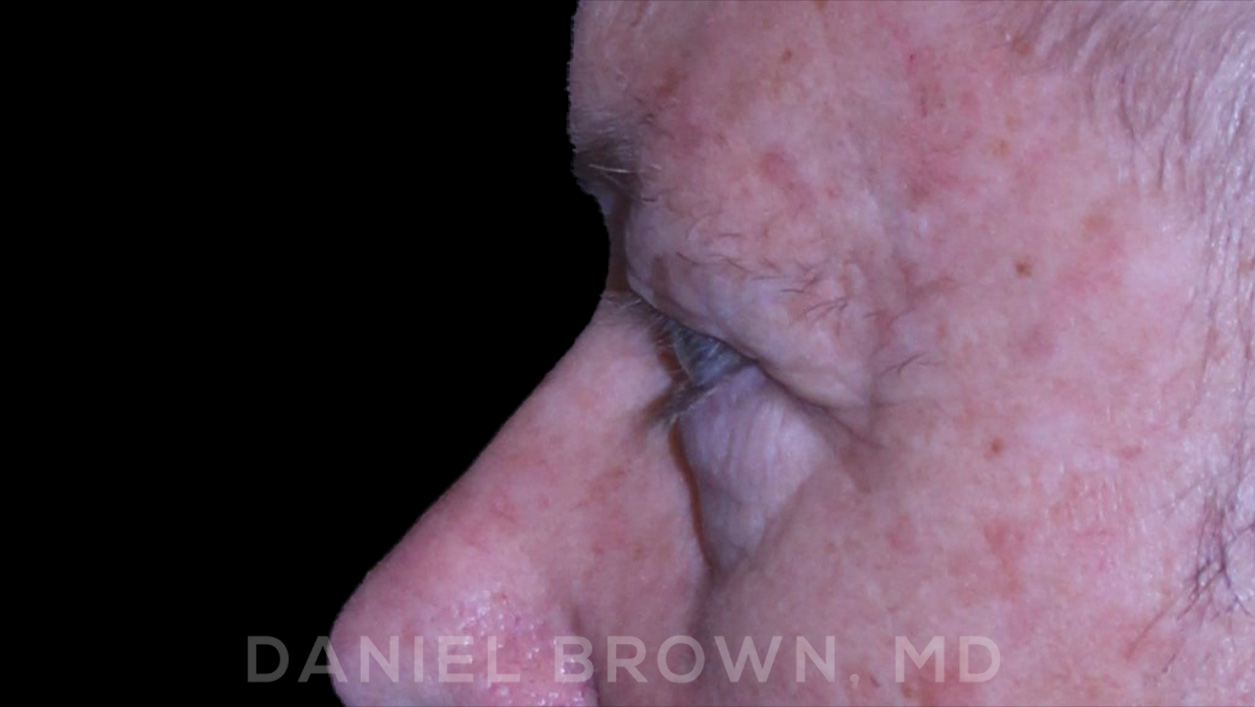 Blepharoplasty Patient Photo - Case 873 - before view-5