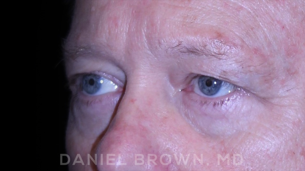 Blepharoplasty Patient Photo - Case 873 - before view-2