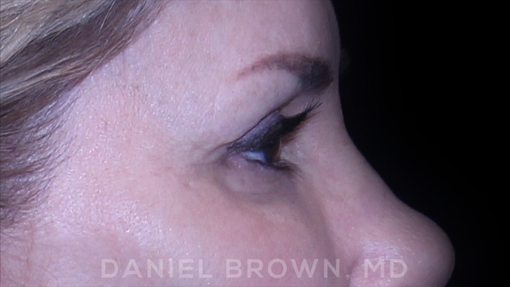 Blepharoplasty Patient Photo - Case 894 - before view-7
