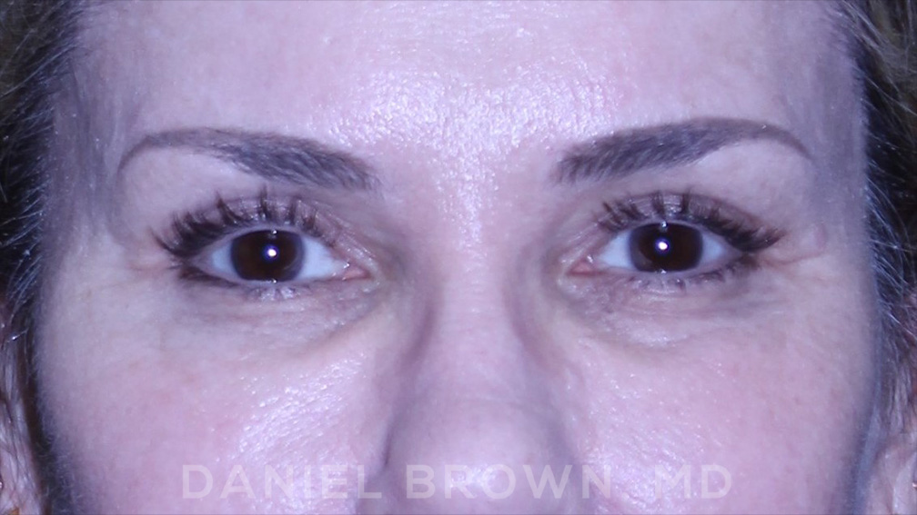 Blepharoplasty Patient Photo - Case 894 - after view-1