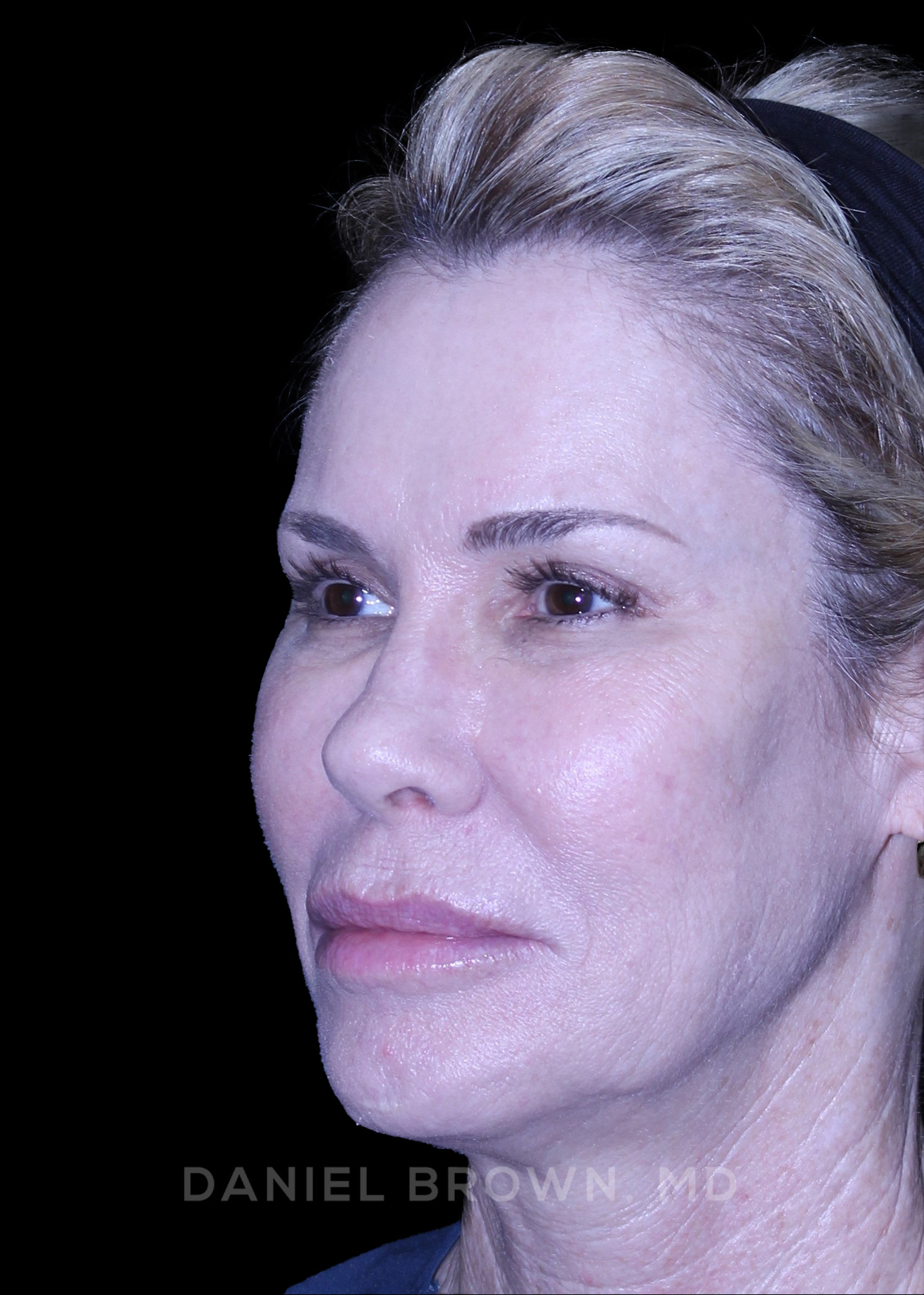 Blepharoplasty Patient Photo - Case 894 - after view