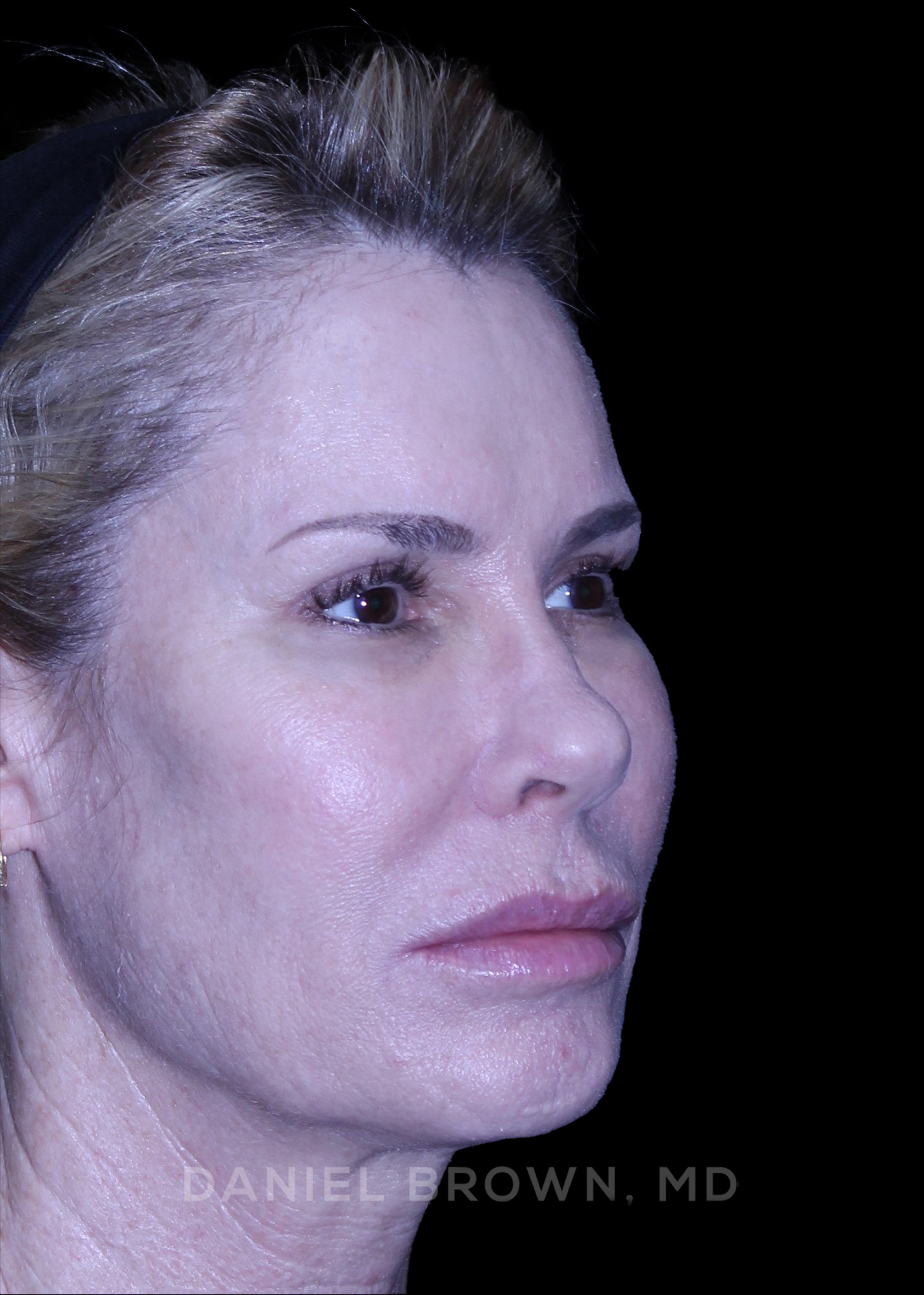 Blepharoplasty Patient Photo - Case 894 - after view-8