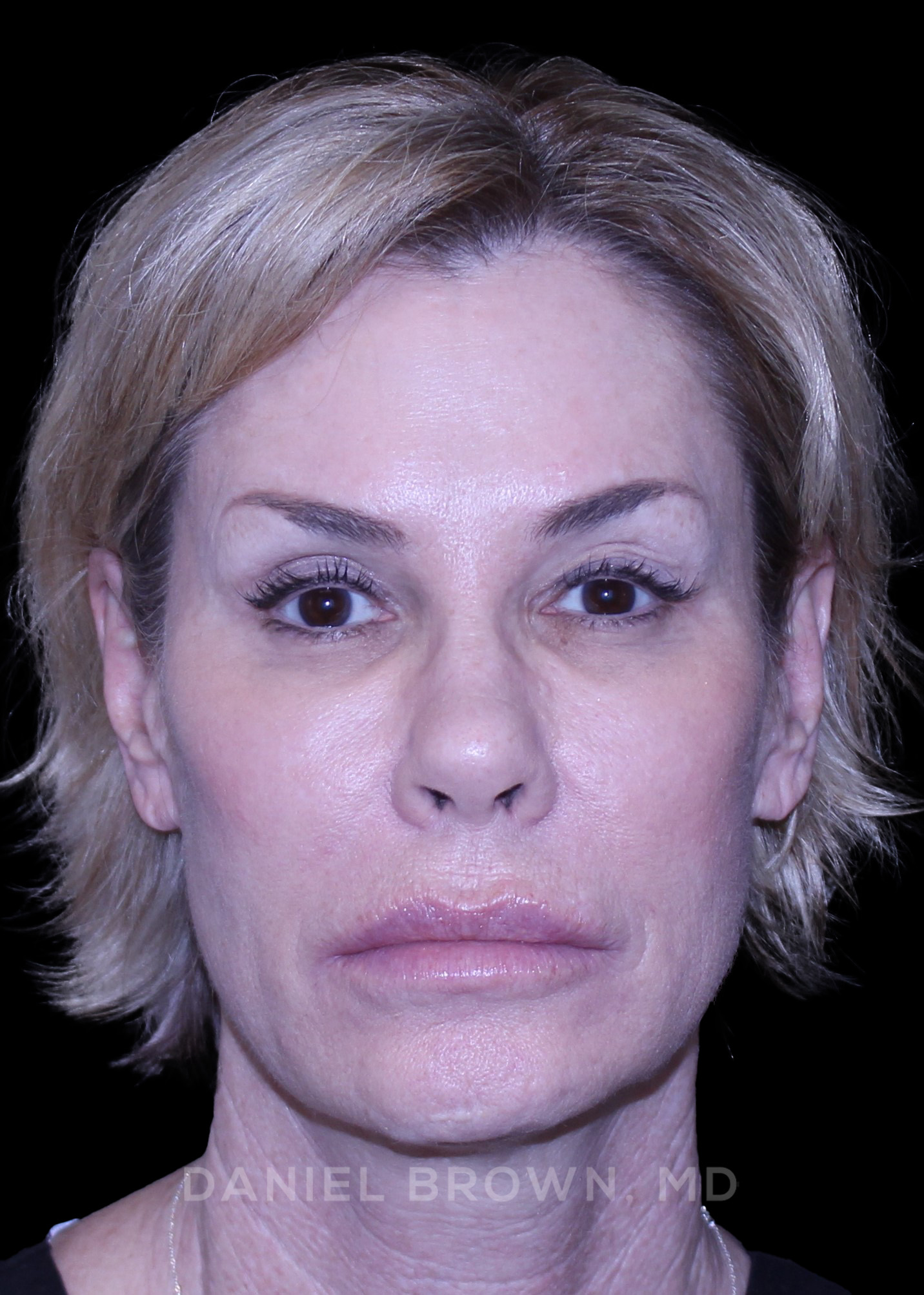 Blepharoplasty Patient Photo - Case 894 - before view-0