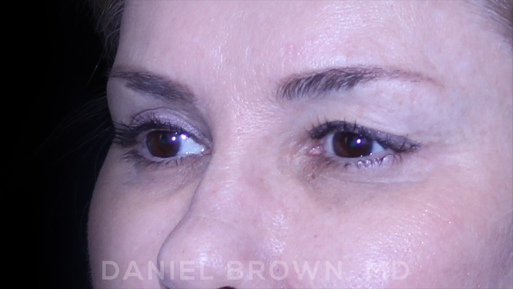 Blepharoplasty Patient Photo - Case 894 - before view-