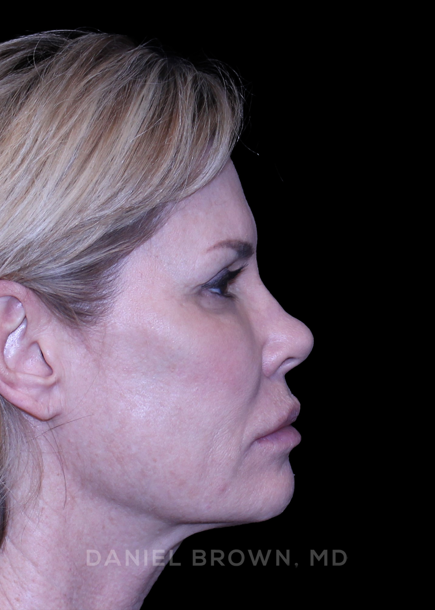 Blepharoplasty Patient Photo - Case 894 - before view-6