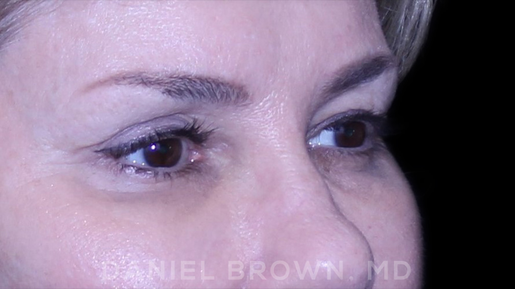 Blepharoplasty Patient Photo - Case 894 - before view-