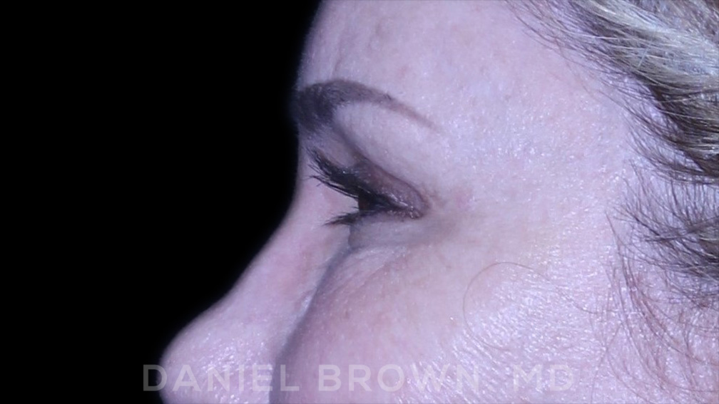 Blepharoplasty Patient Photo - Case 894 - after view